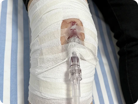 Aplica&ccedil;&atilde;o de gesso para al&iacute;vio de traumas