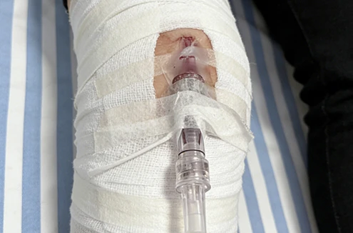 Aplica&ccedil;&atilde;o de gesso para al&iacute;vio de traumas
